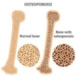 Diagnosing and Assessing Osteoporosis