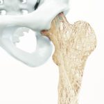 improving osteoporosis screening